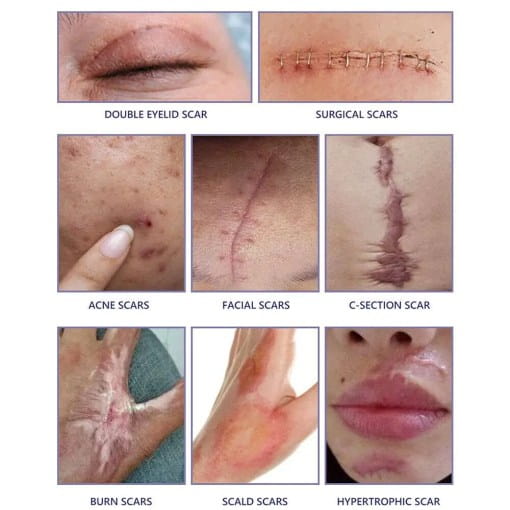 Advanced Scar Cream 20G