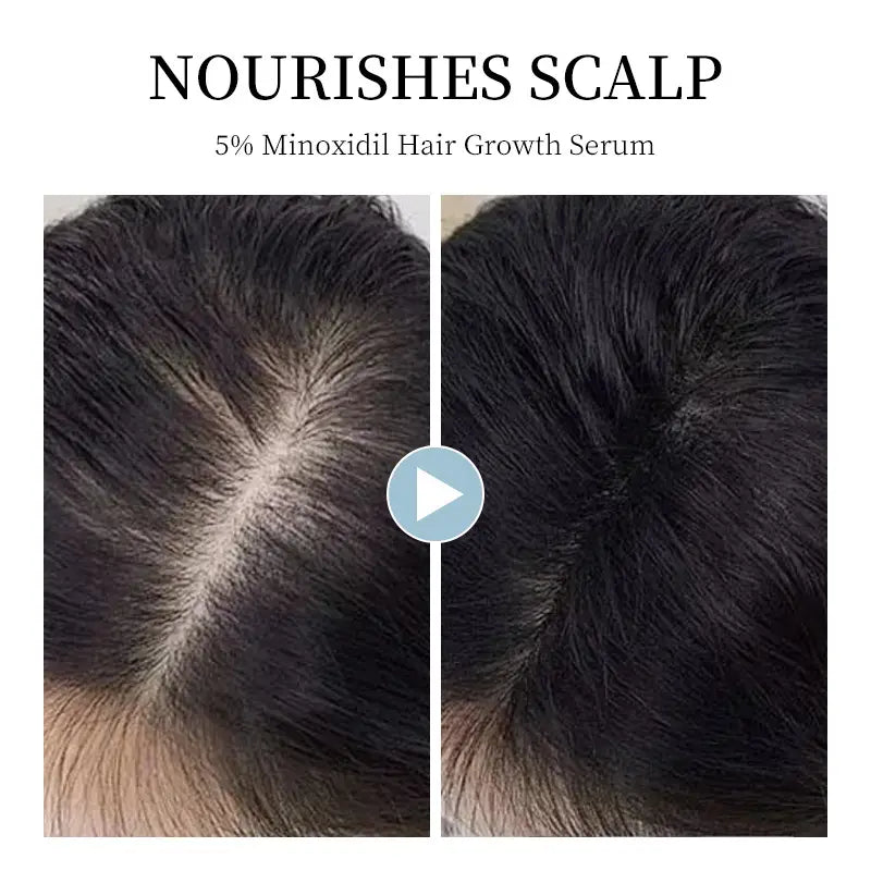 Acondicionador de crecimiento del cabello minoxidil del 5% kormesico con agente cromogénico