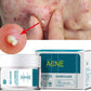 Acne cream - Zap Zits Away with our Magical Acne Cream