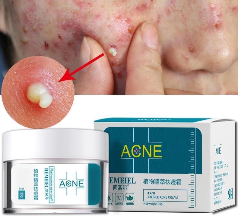 Acne cream - Zap Zits Away with our Magical Acne Cream