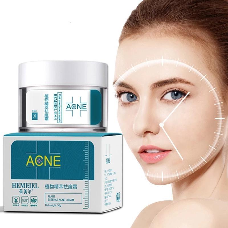 Acne cream - Zap Zits Away with our Magical Acne Cream