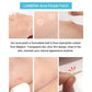 Acne stickers fade acne marks - Bye Bye Zits with these Magical Acne Stickers