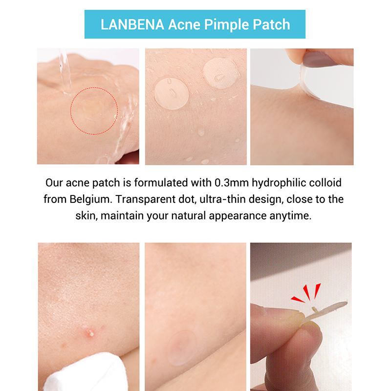 Acne stickers fade acne marks - Bye Bye Zits with these Magical Acne Stickers