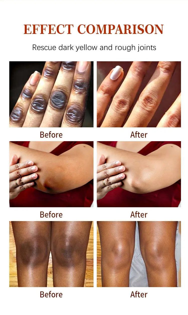 Dark Knuckles Whitening