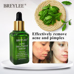 BREYLEE Acne Treatment Serum Face Facial Anti Acne Scar Removal Cream Skin Care Whitening Repair Pimple Remover