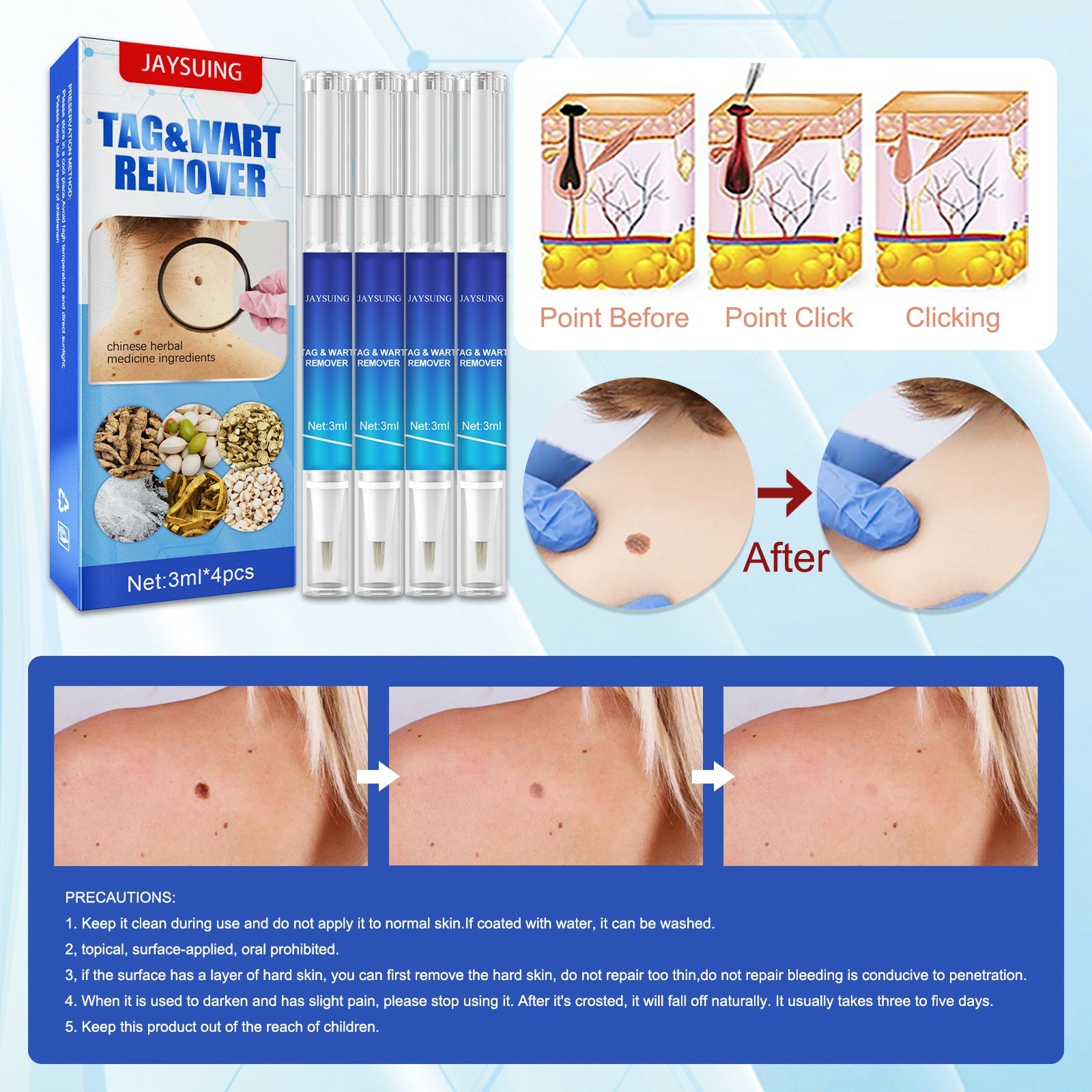 Carnivorous Neck Filiform Wart Removal Kit for Body and - Bold Care carnivorous neck filiform wart body