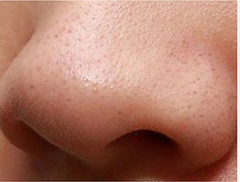 Intelligent Blackhead Absorber Hot Compress for Cleaning and Beauty - Cold Comedic hot compress blackhead cleaning