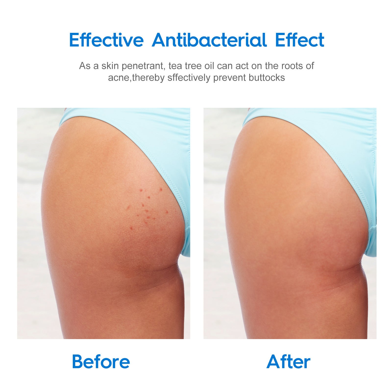 Moisturizing Tea Tree Oil Cream for Acne Scars and Skin Care - Fade Lift Your Butt with Humor fade acne scars butt