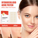 Hydrogel Acne Patch with Invisible Breathable Repair 144pcs - Magic invisible breathable repair hydrogel acne patch