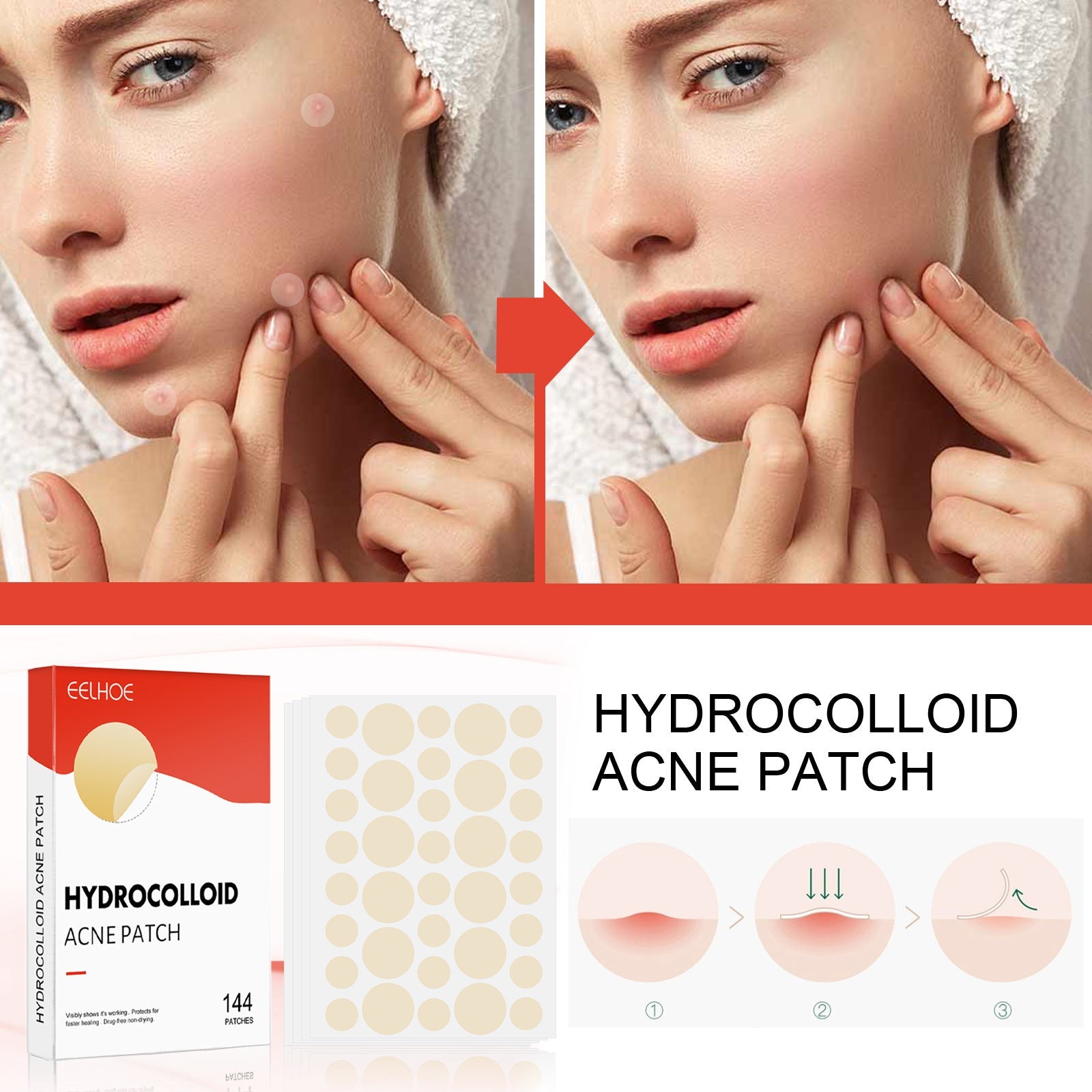 Hydrogel Acne Patch with Invisible Breathable Repair 144pcs - Magic invisible breathable repair hydrogel acne patch