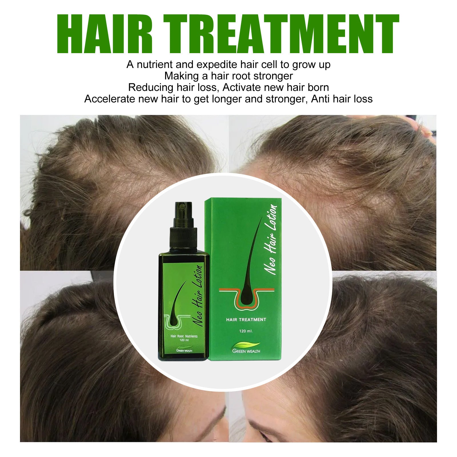 Neo Hair Lotion Serum Natural Spray Oil Kit for Loss Treatment - Teleplus hair loss neo lotion serum product