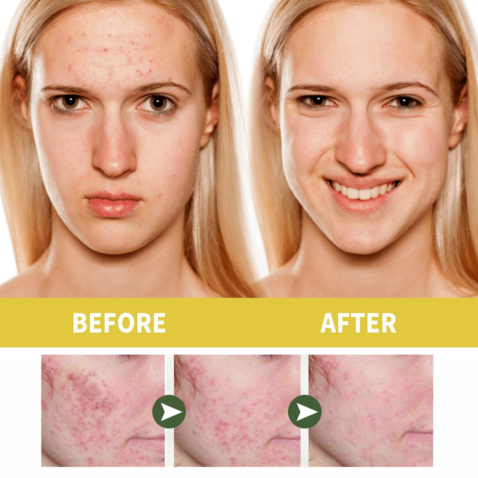 Orchid Acne Treatment Oil with Glycerin and Hyaluronic Acid 30ml - Teleplus orchid acne treatment oil cleansing