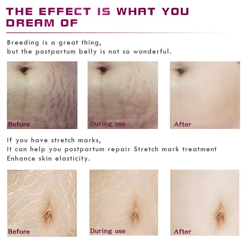 Stretch Mark Remover Essential Oil for Skin Care and Purification - Cream Smooth stretch mark remover essential oil