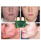 Tea tree acne cream moisturizing acne cream - Tea Tree Acne Cream for Bye Bye Pimples Fun